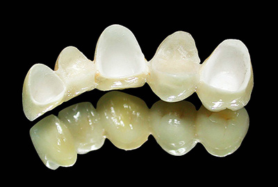 All-ceramic zirconia - All-ceramic zirconia  - All-ceramic zirconia