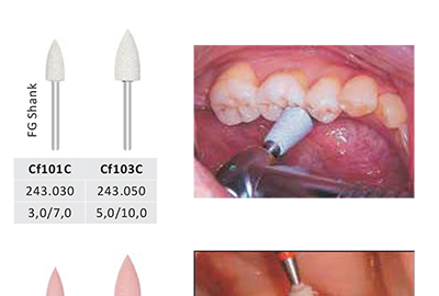 FG Prophy Polisher - BU33  - BU33