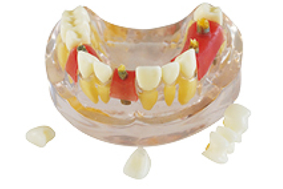 Implant Model - TM-T11