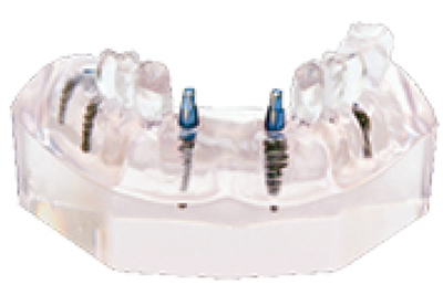 Implant Model - TM-T12