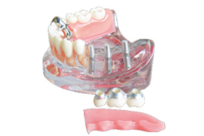 Implant Model - TM-T13
