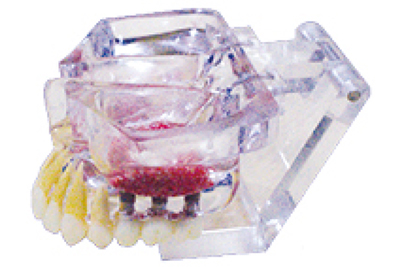 Implant Model - TM-T14